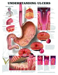 Chart,  Ulcers, (Bachin)  50 x 66cm.